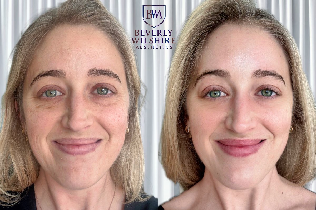 Best Botox in Beverly Hills - BWA - Beverly Hills, CA